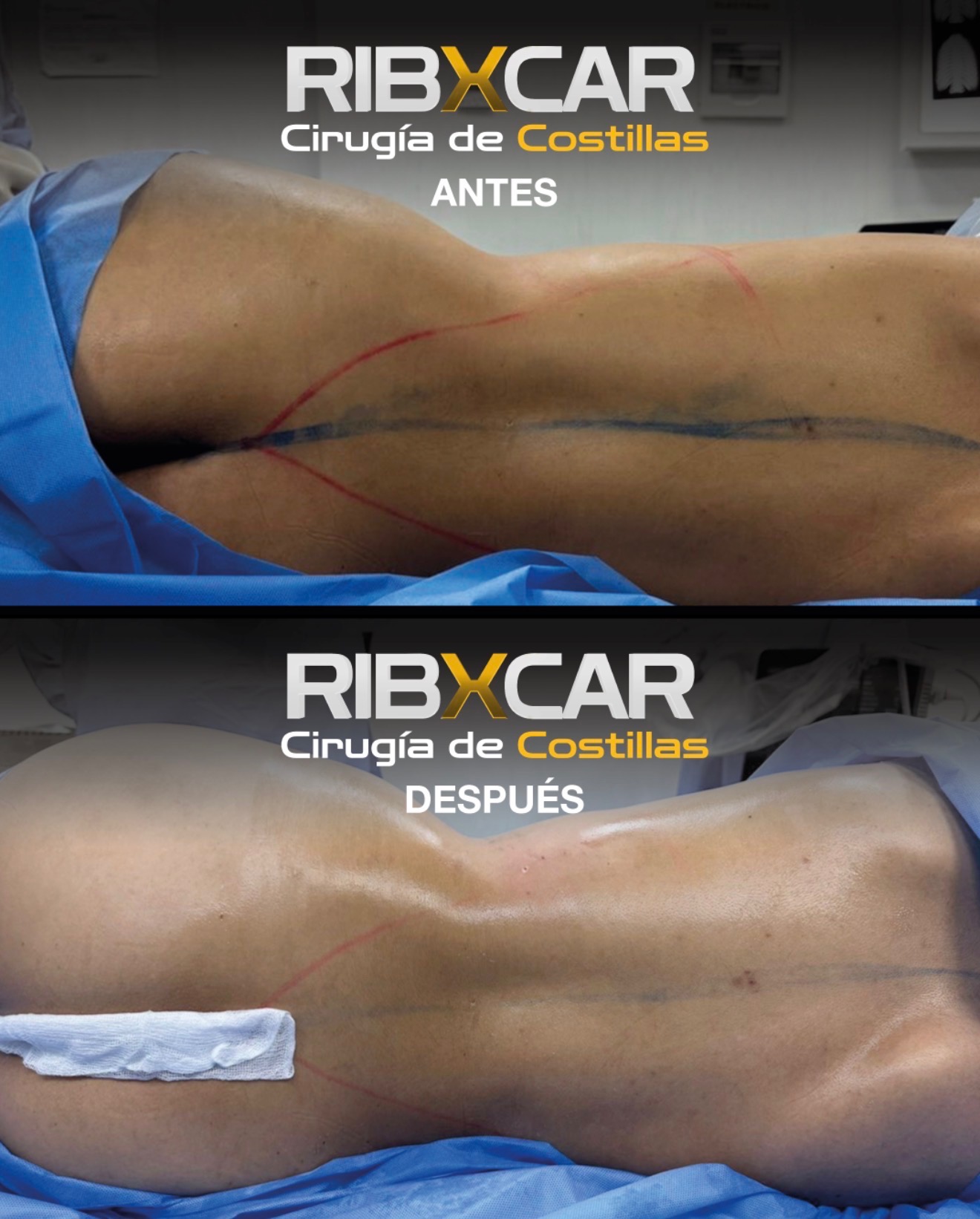 Rib remodeling before and after — side view of torso contour