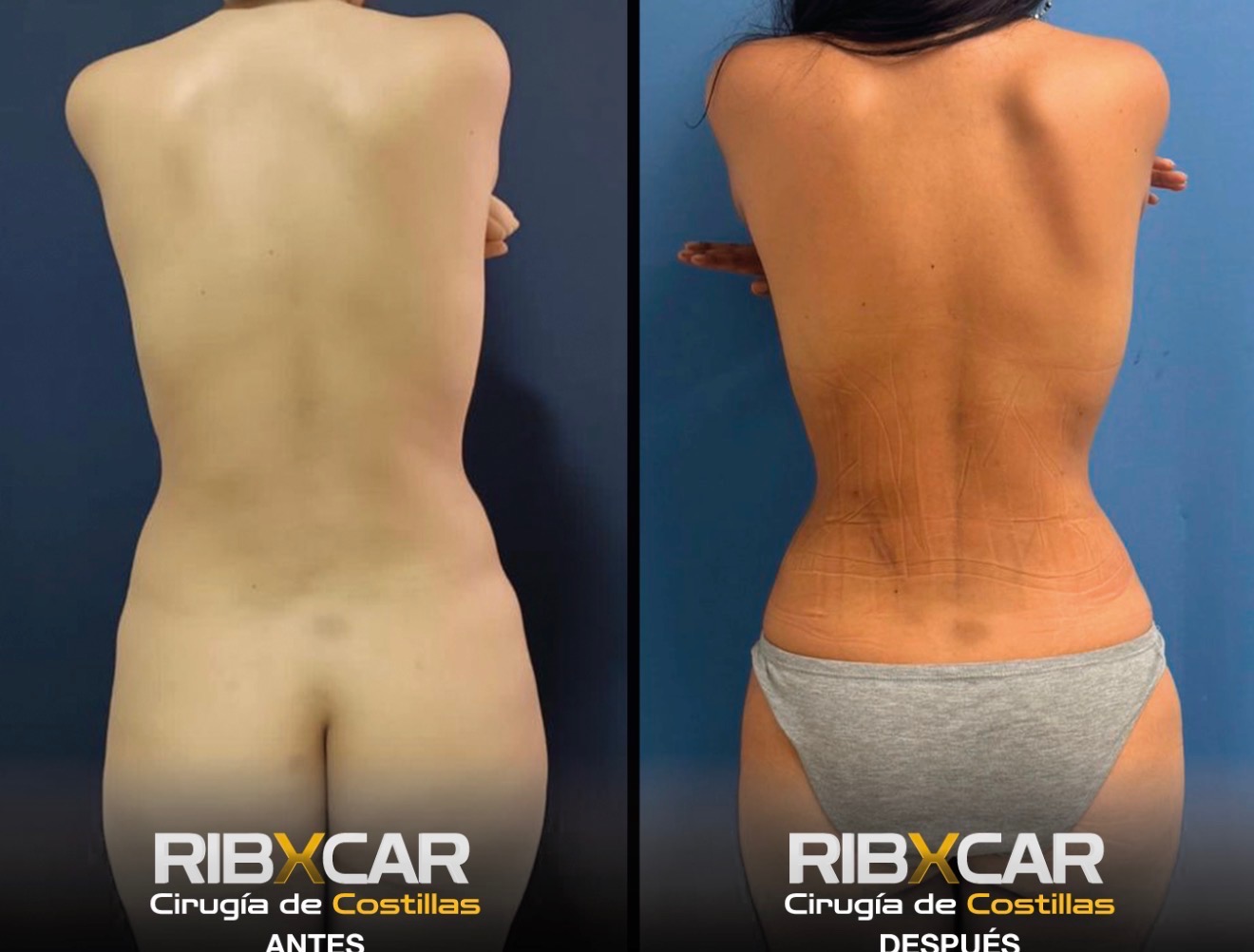 Rib remodeling before and after — back view of hourglass silhouette