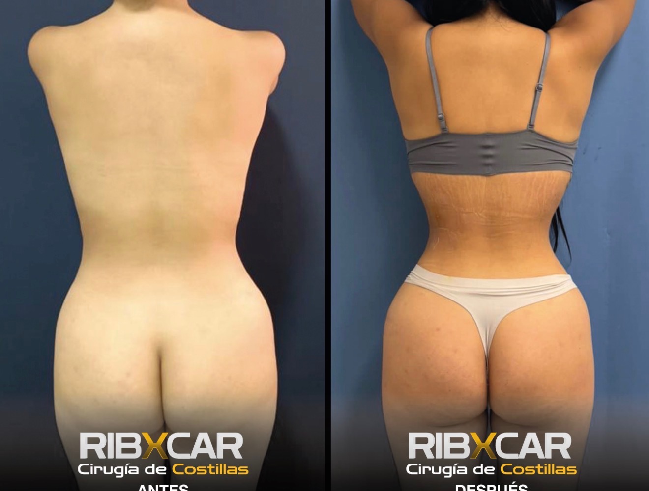 Rib remodeling before and after — back view showing waist definition