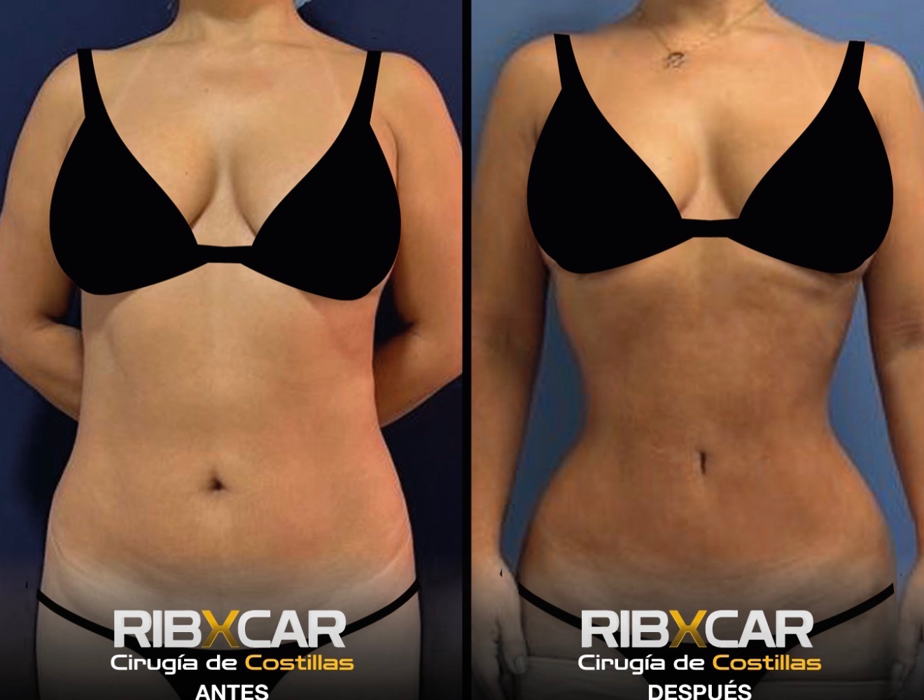 Rib remodeling before and after — front view of narrowed waistline